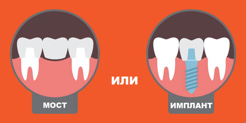 Мост или имплантант